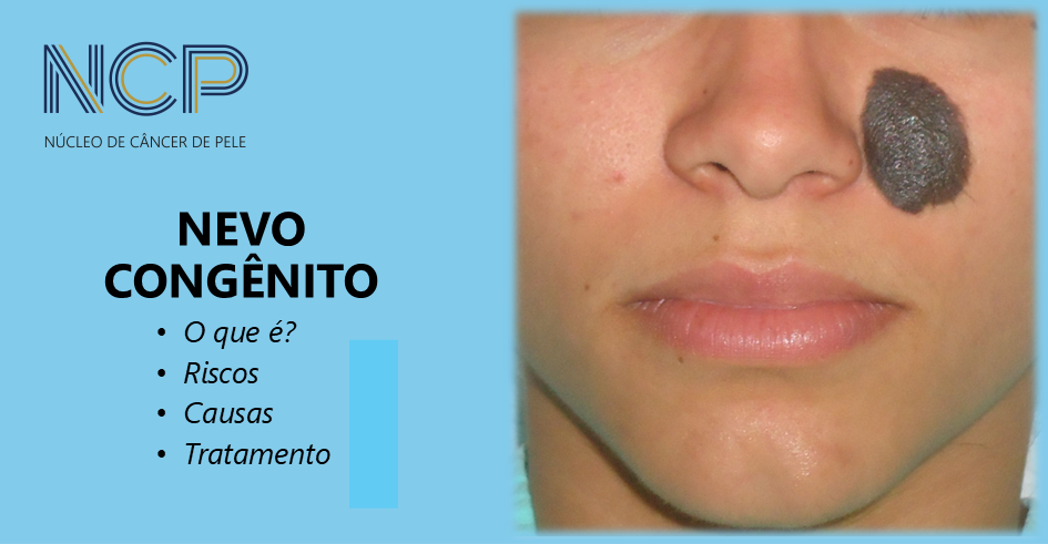 Nevo congênito