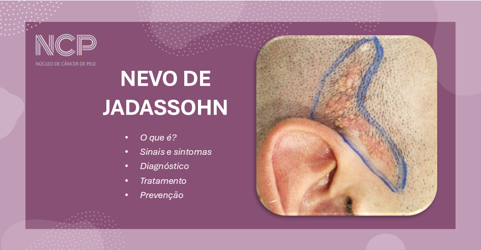 nevo de Jadassohn